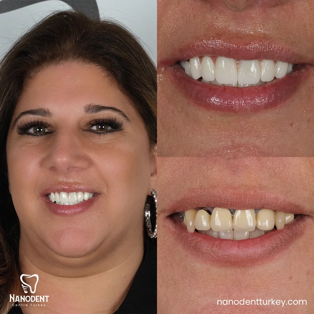 Bilha — Smile Makeover