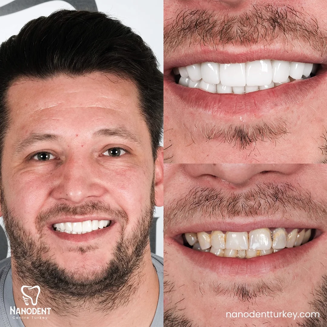 Timothy — Smile Makeover