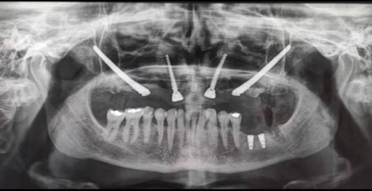 Zygomatic Implant