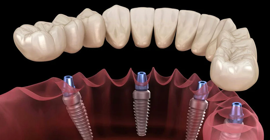 All On 4 Dental Implants