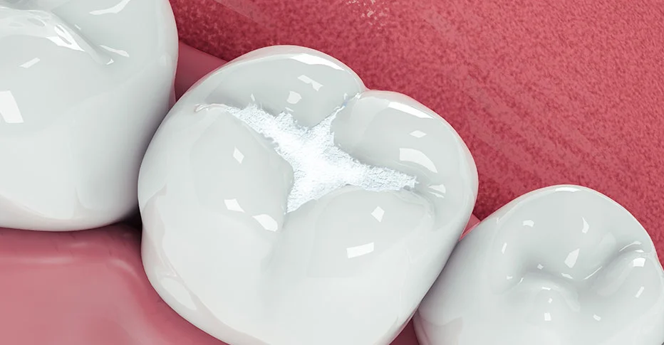 Composite Fillings
