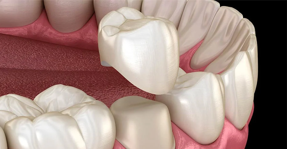 Dental Crowns