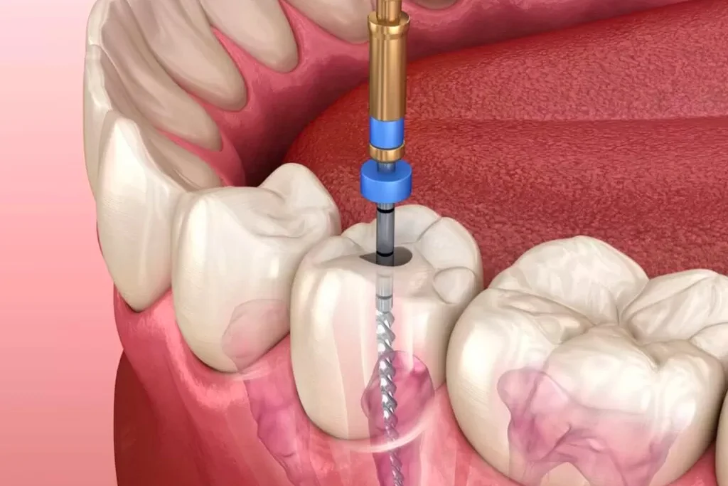 Root Canal Treatment