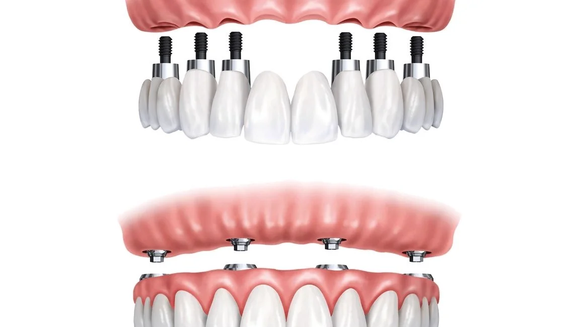 All on 6 Dental Implants